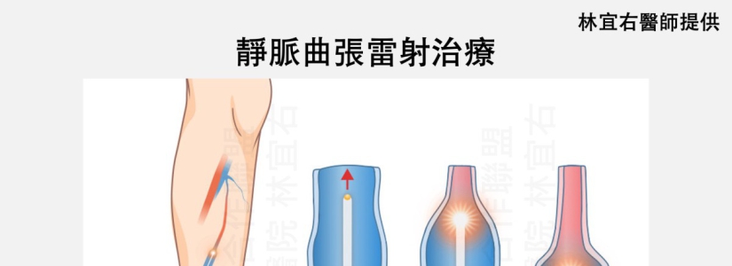 久站造成雙腿腫脹 靜脈曲張微創手術助重返輕盈步伐