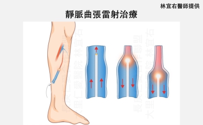 久站造成雙腿腫脹 靜脈曲張微創手術助重返輕盈步伐