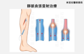 久站造成雙腿腫脹 靜脈曲張微創手術助重返輕盈步伐