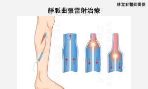 久站造成雙腿腫脹 靜脈曲張微創手術助重返輕盈步伐