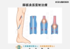 久站造成雙腿腫脹 靜脈曲張微創手術助重返輕盈步伐