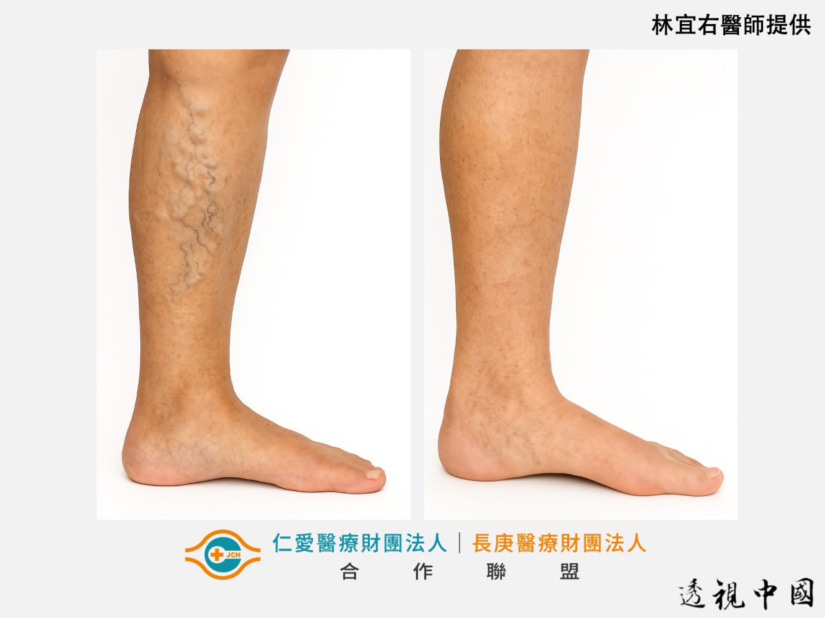 久站造成雙腿腫脹 靜脈曲張微創手術助重返輕盈步伐（圖：仁愛長庚合作聯盟醫院（大里仁愛醫院）提供）-透视中国