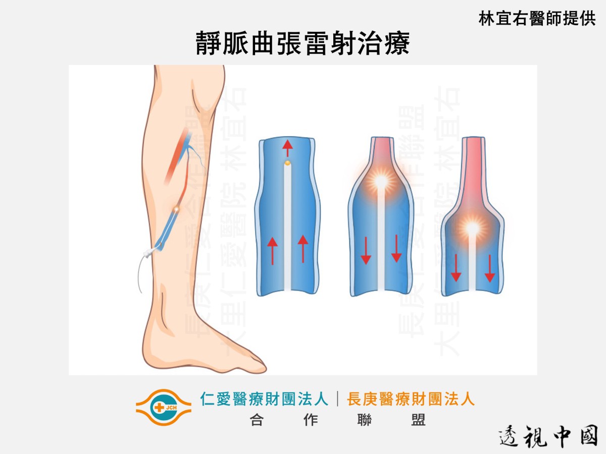久站造成雙腿腫脹 靜脈曲張微創手術助重返輕盈步伐（圖：仁愛長庚合作聯盟醫院（大里仁愛醫院）提供）-透视中国